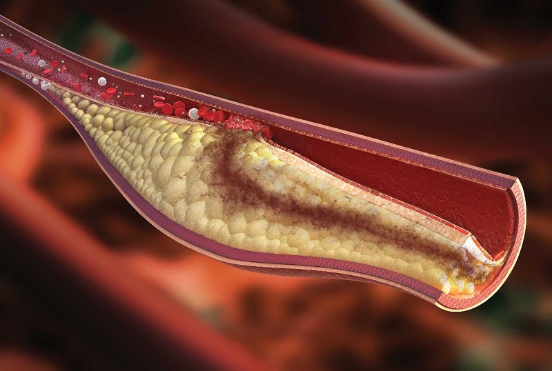 Tư vấn về tình trạng tăng lipid máu và cách cải thiện