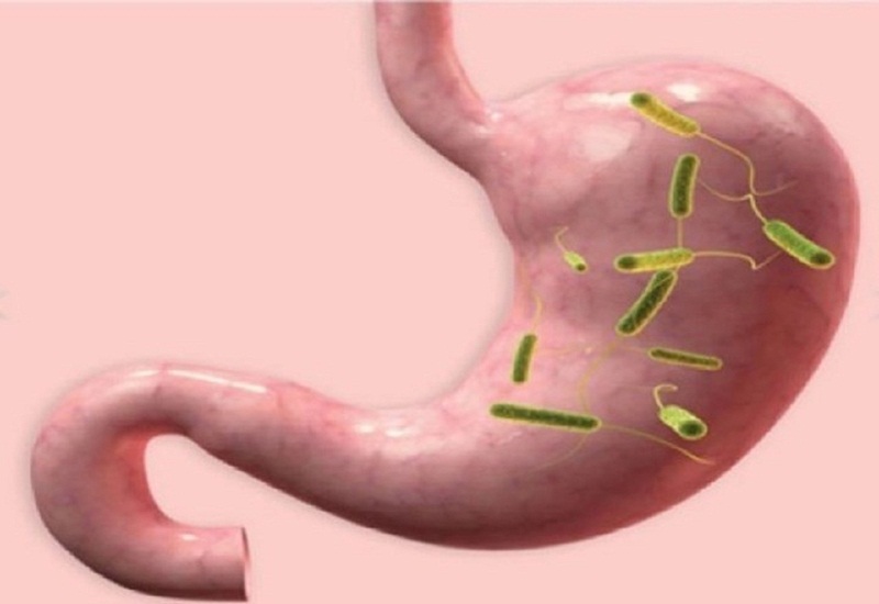 Bác sĩ tư vấn: Kết quả xét nghiệm Helicobacter pylori dương tính nên làm gì?