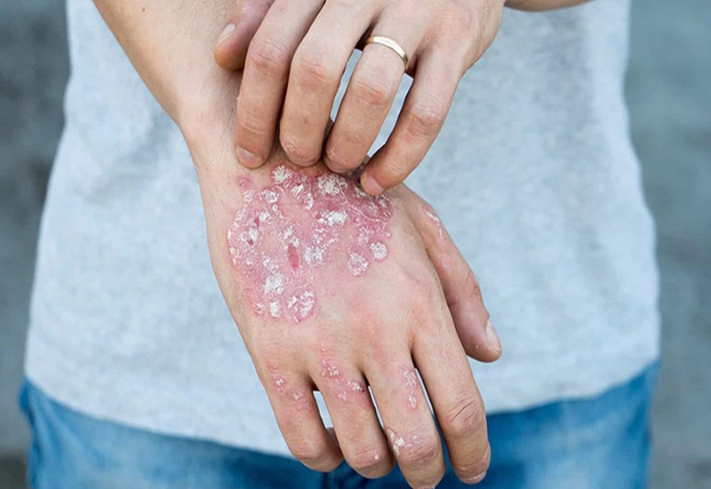 Cách trị bệnh eczema an toàn, hiệu quả và nhanh chóng tại nhà