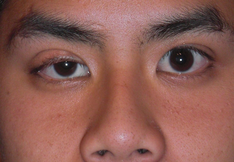 Bị sụp mí mắt phải làm sao? Nguyên nhân và cách điều trị | Medlatec