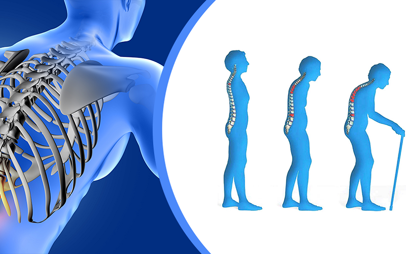 Loãng xương do điều trị ung thư vú - nguyên nhân và cách khắc phục |  Medlatec