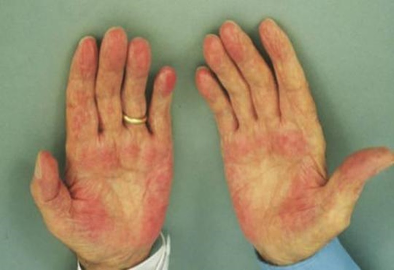 Bác sĩ giải đáp thắc mắc: Bàn tay son có phải dấu hiệu của bệnh gan?
