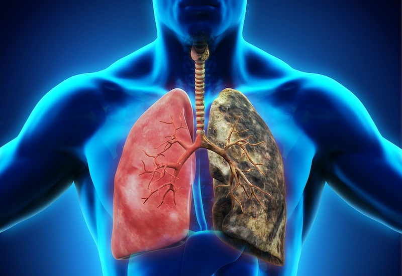 Ung thư phổi có triệu chứng như thế nào và phương án điều trị là gì? |  Medlatec