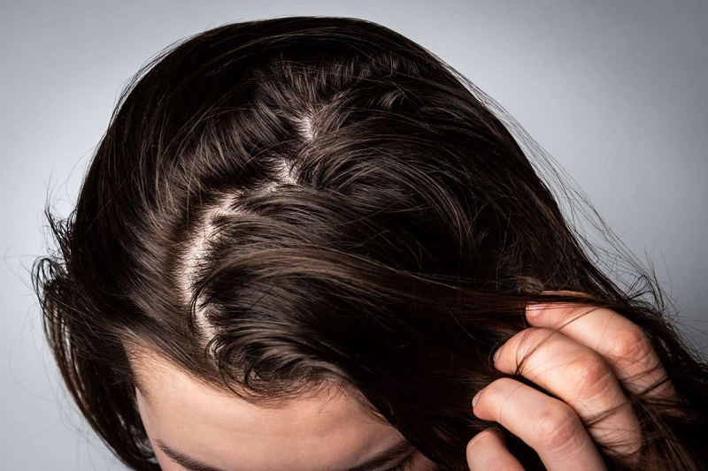 Nguyên nhân khiến tóc bị bết dầu & Cách trị tóc bết dầu cực hiệu quả, cho mái tóc bồng bềnh