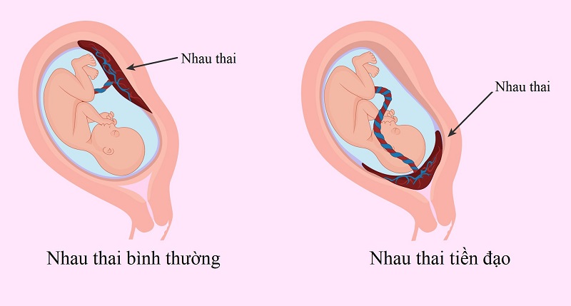 4. Nguy Cơ Và Biến Chứng Có Thể Xảy Ra Với Nhau Tiền Đạo