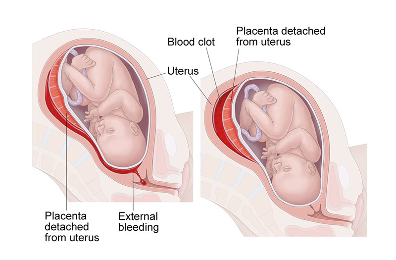 Xuất huyết quanh túi thai: Nguyên nhân triệu chứng và biến chứng