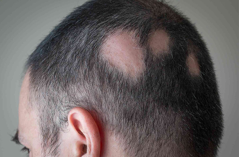 Rụng tóc từng mảng là bệnh gì Có cách nào trị được không