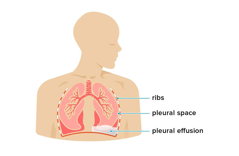 Giải đáp: Tình trạng tràn dịch màng phổi có nguy hiểm không?