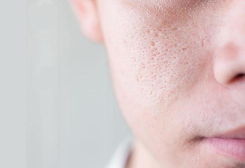 Cách điều trị sẹo rỗ để lấy lại vẻ mịn màng cho làn da | Medlatec