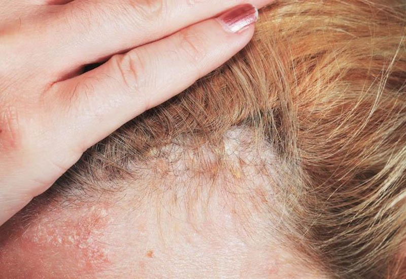 Nguyên nhân gây bệnh vẩy nến da đầu?  |  Medlatec