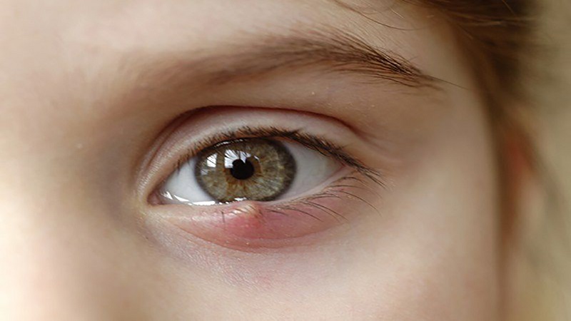 Lẹo mắt - nguyên nhân - triệu chứng và biện pháp điều trị | Medlatec