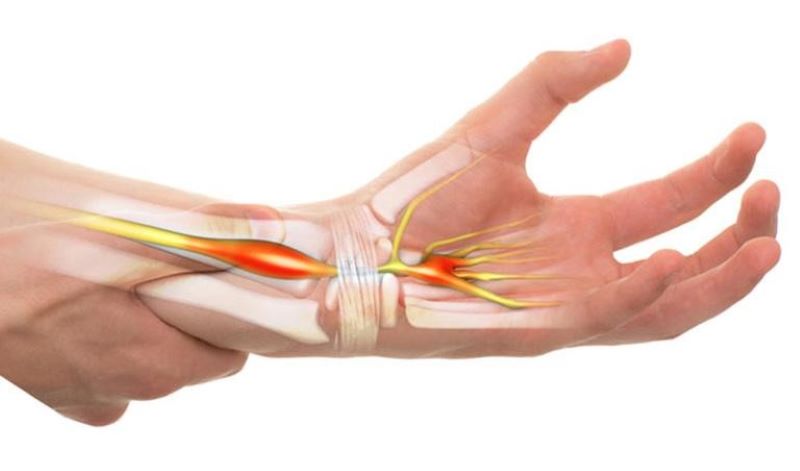 Hội chứng ống cổ tay và những thông tin nhất định cần biết
