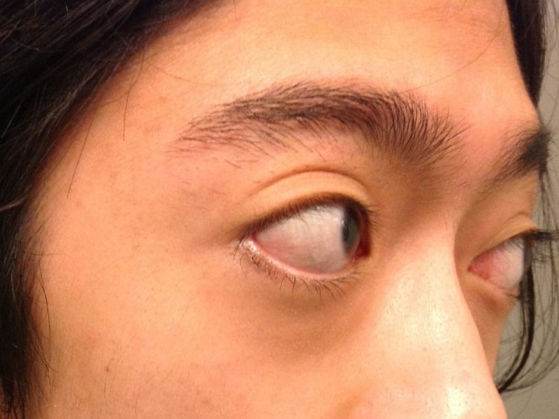 Mắt lồi là gì? Nguyên nhân và cách điều trị