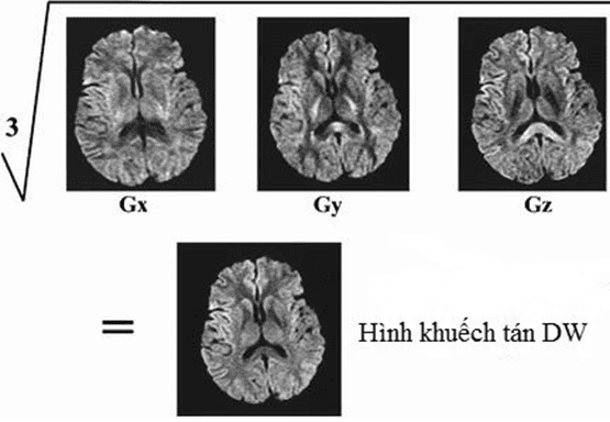 Chụp cộng hưởng từ khuếch tán (DWI) vai trò trong chẩn đoán bệnh lý não.