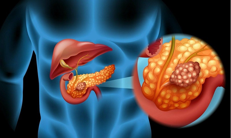 Tiên lượng bệnh nhân bị ung thư tuyến tụy sống được bao lâu?